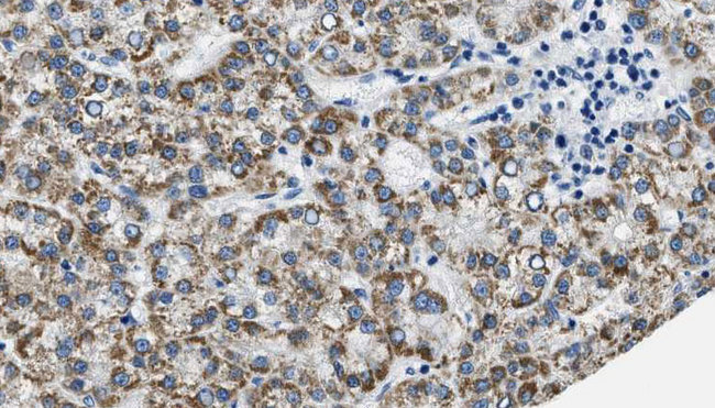 PTGER3 / EP3 Antibody - 1:100 staining human liver carcinoma tissues by IHC-P. The sample was formaldehyde fixed and a heat mediated antigen retrieval step in citrate buffer was performed. The sample was then blocked and incubated with the antibody for 1.5 hours at 22°C. An HRP conjugated goat anti-rabbit antibody was used as the secondary.
