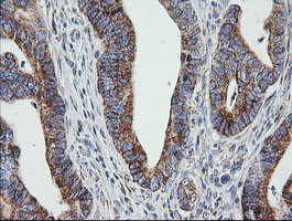 PTGES2 Antibody - IHC of paraffin-embedded Adenocarcinoma of Human colon tissue using anti-PTGES2 mouse monoclonal antibody.