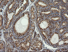 PTGES2 Antibody - IHC of paraffin-embedded Carcinoma of Human thyroid tissue using anti-PTGES2 mouse monoclonal antibody.