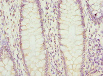 PTGES2 Antibody - Immunohistochemistry of paraffin-embedded human colon cancer at dilution 1:100