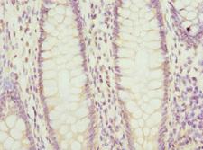 PTGES2 Antibody - Immunohistochemistry of paraffin-embedded human colon cancer at dilution 1:100