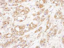PTGES3 / p23 Antibody - Detection of human P23 by immunohistochemistry. Sample: FFPE section of human ovarian carcinoma. Antibody: Affinity purified rabbit anti- P23 used at a dilution of 1:5,000 (0.2µg/ml). Detection: DAB