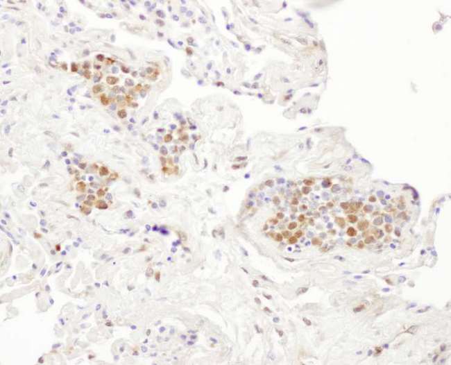 PTGES3 / p23 Antibody - Detection of human P23 by immunohistochemistry. Sample: FFPE section of human lung cancer. Antibody: Affinity purified rabbit anti- P23 used at a dilution of 1:5,000 (0.2µg/ml). Detection: DAB