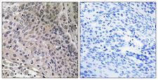 PTGES3 / p23 Antibody - Immunohistochemistry analysis of paraffin-embedded human breast carcinoma tissue, using TEBP Antibody. The picture on the right is blocked with the synthesized peptide.