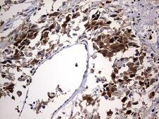 PTGES3 / p23 Antibody - IHC of paraffin-embedded Adenocarcinoma of Human ovary tissue using anti-PTGES3 mouse monoclonal antibody. (Heat-induced epitope retrieval by 10mM citric buffer, pH6.0, 120°C for 3min).