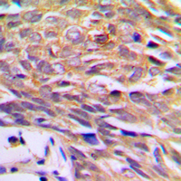 PTGES3 / p23 Antibody - Immunohistochemical analysis of p23 staining in human prostate cancer formalin fixed paraffin embedded tissue section. The section was pre-treated using heat mediated antigen retrieval with sodium citrate buffer (pH 6.0). The section was then incubated with the antibody at room temperature and detected using an HRP-conjugated compact polymer system. DAB was used as the chromogen. The section was then counterstained with hematoxylin and mounted with DPX.