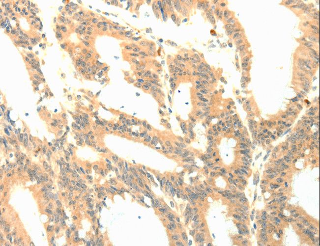 PTGES3 / p23 Antibody - Immunohistochemistry of paraffin-embedded Human colon cancer using PTGES3 Polyclonal Antibody at dilution of 1:50.