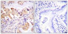 PTGES3 / p23 Antibody - Peptide - + Immunohistochemistry analysis of paraffin-embedded human lung carcinoma tissue using TEBP (Ab-113) antibody.