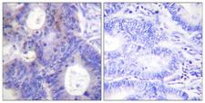 PTGES3 / p23 Antibody - Immunohistochemistry analysis of paraffin-embedded human colon carcinoma, using TEBP (Phospho-Ser113) Antibody. The picture on the right is blocked with the phospho peptide.