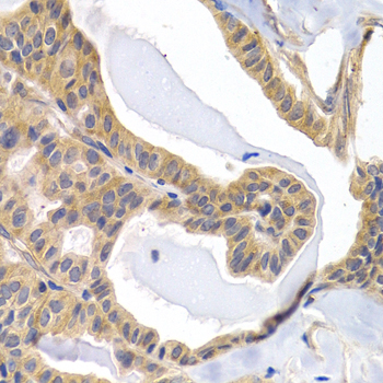 PTGIR / IP Receptor Antibody - Immunohistochemistry of paraffin-embedded human thyroid cancer tissue.