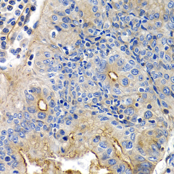 PTGIR / IP Receptor Antibody - Immunohistochemistry of paraffin-embedded human colon cancer tissue.