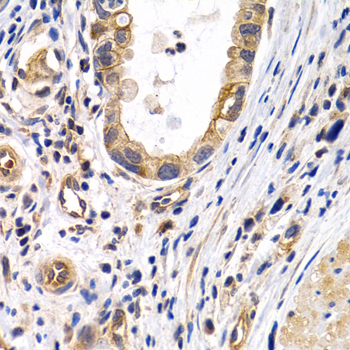 PTGIR / IP Receptor Antibody - Immunohistochemistry of paraffin-embedded human stomach cancer tissue.