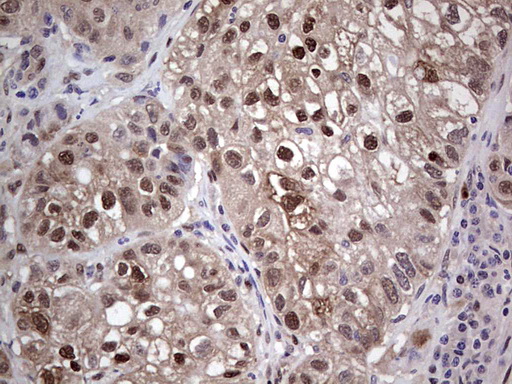 PTGS2 / COX2 / COX-2 Antibody - Immunohistochemical staining of paraffin-embedded Carcinoma of Human lung tissue using anti-PTGS2 mouse monoclonal antibody. (Heat-induced epitope retrieval by 1 mM EDTA in 10mM Tris, pH8.5, 120C for 3min,