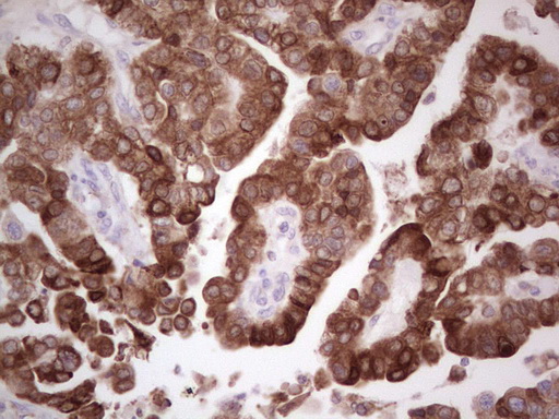 PTGS2 / COX2 / COX-2 Antibody - Immunohistochemical staining of paraffin-embedded Adenocarcinoma of Human ovary tissue using anti-PTGS2 mouse monoclonal antibody. (Heat-induced epitope retrieval by 1 mM EDTA in 10mM Tris, pH8.5, 120C for 3min,