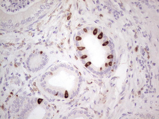 PTGS2 / COX2 / COX-2 Antibody - IHC of paraffin-embedded Carcinoma of Human pancreas tissue using anti-PTGS2 mouse monoclonal antibody. (Heat-induced epitope retrieval by 1 mM EDTA in 10mM Tris, pH8.5, 120°C for 3min).