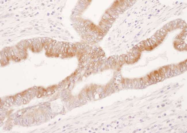 PTGS2 / COX2 / COX-2 Antibody - Detection of Human COX-2 by Immunohistochemistry. Sample: FFPE section of human colon carcinoma. Antibody: Affinity purified rabbit anti-COX-2 used at a dilution of 1:1000 (1 ug/ml). Detection: DAB.