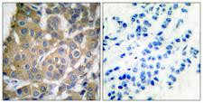 PTGS2 / COX2 / COX-2 Antibody - Immunohistochemistry analysis of paraffin-embedded human breast carcinoma tissue, using Cox2 Antibody. The picture on the right is blocked with the synthesized peptide.