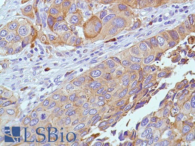 PTGS2 / COX2 / COX-2 Antibody - Immunohistochemistry of Human Bladder Transitional Cell Carcinoma stained with anti-COX-2 antibody