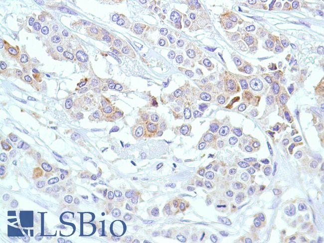 PTGS2 / COX2 / COX-2 Antibody - Immunohistochemistry of Human Breast Ductal Carcinoma stained with anti-COX-2 antibody