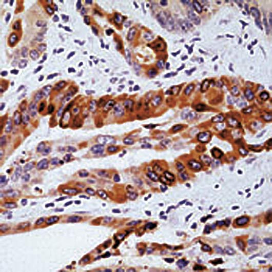 PTGS2 / COX2 / COX-2 Antibody - Formalin-fixed, paraffin-embedded human colon carcinoma stained with COX2 antibody.