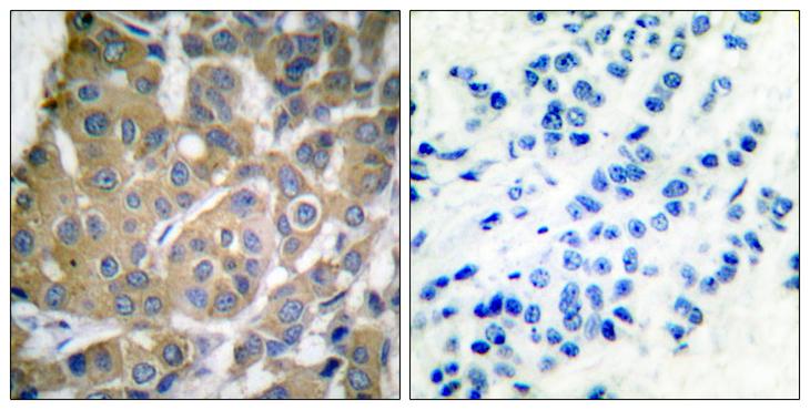 PTGS2 / COX2 / COX-2 Antibody - Peptide - + Immunohistochemical analysis of paraffin-embedded human breast carcinoma tissue using Cox2 antibody.