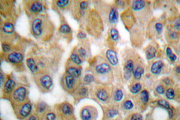 PTGS2 / COX2 / COX-2 Antibody - IHC of Cox2/PGHS2 (T594) pAb in paraffin-embedded human breast carcinoma tissue.