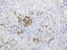 PTH / Parathyroid Hormone Antibody - IHC of paraffin-embedded Carcinoma of Human lung tissue using anti-PTH mouse monoclonal antibody.