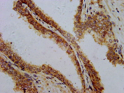 PTH / Parathyroid Hormone Antibody - IHC image of PTH Antibody diluted at 1:700 and staining in paraffin-embedded human prostate cancer performed on a Leica BondTM system. After dewaxing and hydration, antigen retrieval was mediated by high pressure in a citrate buffer (pH 6.0). Section was blocked with 10% normal goat serum 30min at RT. Then primary antibody (1% BSA) was incubated at 4°C overnight. The primary is detected by a biotinylated secondary antibody and visualized using an HRP conjugated SP system.