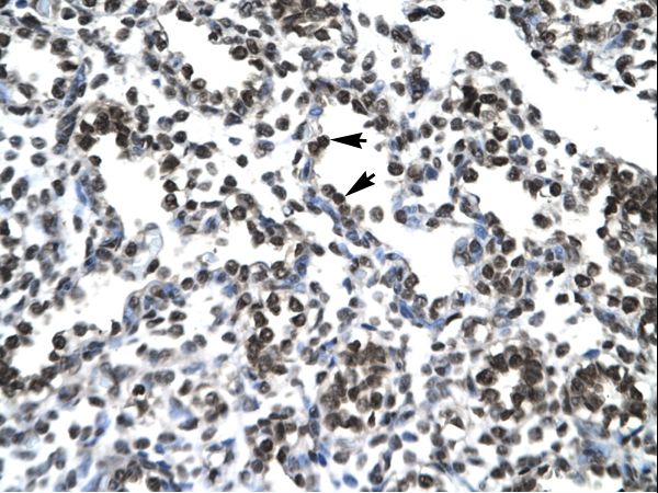 PTHLH / PTHRP Antibody - PTHLH / PTHRP antibody ARP33885_T100-NP_002811-PTHLH (parathyroid hormone-like hormone) Antibody was used in IHC to stain formalin-fixed, paraffin-embedded human lung.  This image was taken for the unconjugated form of this product. Other forms have not been tested.