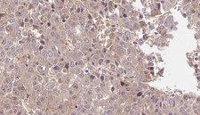 PTHR / PTHR1 Antibody - 1:100 staining human liver carcinoma tissues by IHC-P. The sample was formaldehyde fixed and a heat mediated antigen retrieval step in citrate buffer was performed. The sample was then blocked and incubated with the antibody for 1.5 hours at 22°C. An HRP conjugated goat anti-rabbit antibody was used as the secondary.