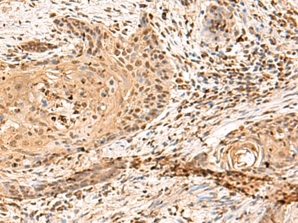 PTHR / PTHR1 Antibody - Immunohistochemistry of paraffin-embedded Human esophagus cancer tissue  using PTH1R Polyclonal Antibody at dilution of 1:65(×200)