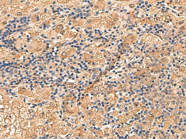 PTHR / PTHR1 Antibody - Immunohistochemistry of paraffin-embedded Human liver cancer tissue  using PTH1R Polyclonal Antibody at dilution of 1:55(×200)