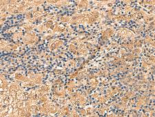 PTHR / PTHR1 Antibody - Immunohistochemistry of paraffin-embedded Human liver cancer tissue  using PTH1R Polyclonal Antibody at dilution of 1:55(×200)