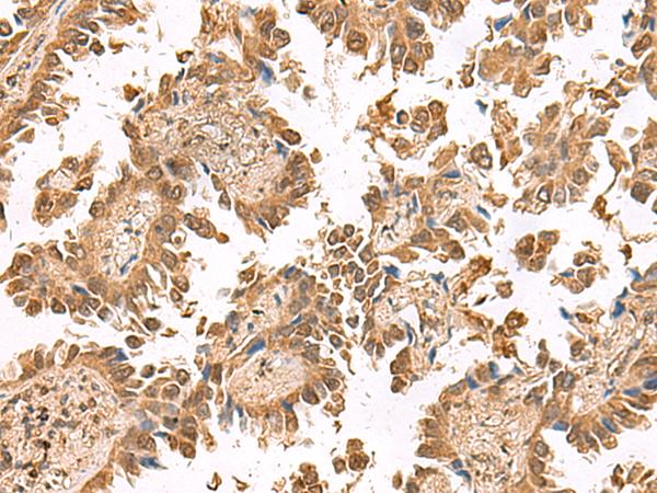 PTHR / PTHR1 Antibody - Immunohistochemistry of paraffin-embedded Human lung cancer tissue  using PTH1R Polyclonal Antibody at dilution of 1:55(×200)
