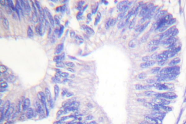 PTK2B / PYK2 Antibody - IHC of PYK2 (I574) pAb in paraffin-embedded human brain colon carcinoma tissue.