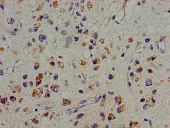 PTK2B / PYK2 Antibody - Immunohistochemistry image of paraffin-embedded human glioma cancer at a dilution of 1:100
