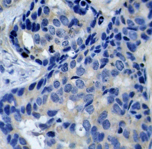 PTK2B / PYK2 Antibody - Immunohistochemical analysis of paraffin-embedded human breast carcinoma tissue.