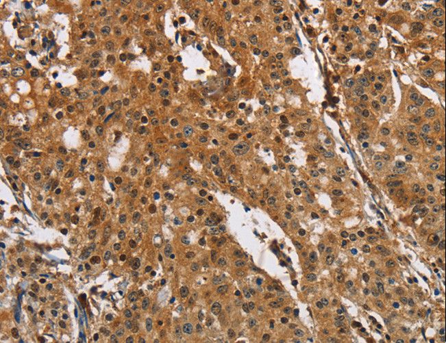 PTK6 / BRK Antibody - Immunohistochemistry of paraffin-embedded Human gastric cancer using PTK6 Polyclonal Antibody at dilution of 1:40.