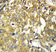 PTN / Pleiotrophin Antibody - PTN / Pleiotrophin antibody. IHC(P): Human Breast Cancer Tissue.