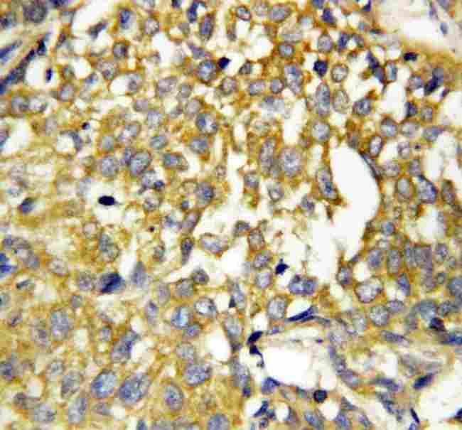 PTN / Pleiotrophin Antibody - Anti-Pleiotrophin antibody, IHC(P): Human Mammary Cancer Tissue