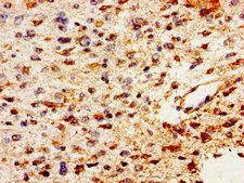 PTN / Pleiotrophin Antibody - Immunohistochemistry image of paraffin-embedded human glioma cancer at a dilution of 1:100