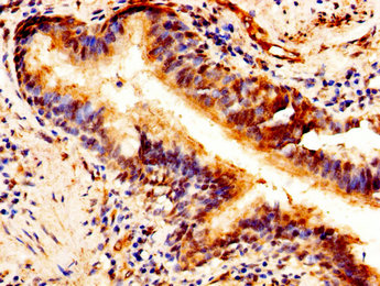 PTN / Pleiotrophin Antibody - Immunohistochemistry image of paraffin-embedded human lung cancer at a dilution of 1:100