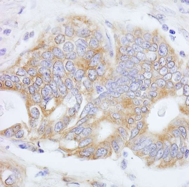 PTP-PEST / PTPN12 Antibody - Detection of Human PTPN12/PTP-PEST by Immunohistochemistry. Sample: FFPE section of human stomach carcinoma. Antibody: Affinity purified rabbit anti-PTPN12/PTP-PEST used at a dilution of 1:200 (1 ug/ml). Detection: DAB.