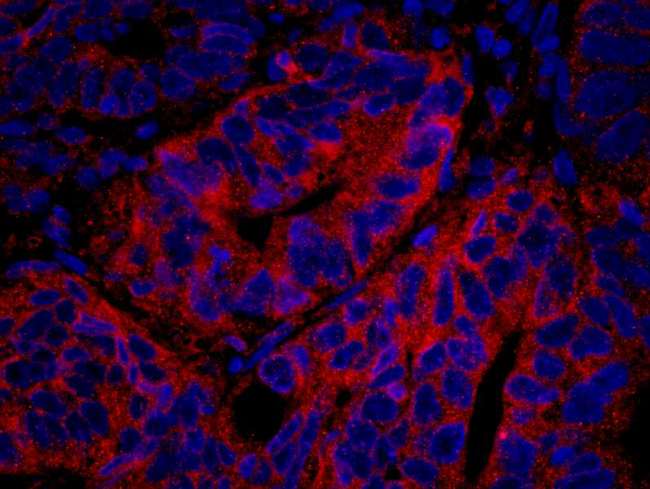 PTP-PEST / PTPN12 Antibody - Detection of Human PTPN12/PTP-PEST by Immunofluorescence. Sample: FFPE section of human colon carcinoma. Antibody: Affinity purified rabbit anti-PTPN12/PTP-PEST used at a dilution of 1:250. Detection: Red-fluorescent goat anti-rabbit IgG highly cross-adsorbed IHC Antibody Hilyte Plus 555 (A120-501E) used at a dilution of 1:100.