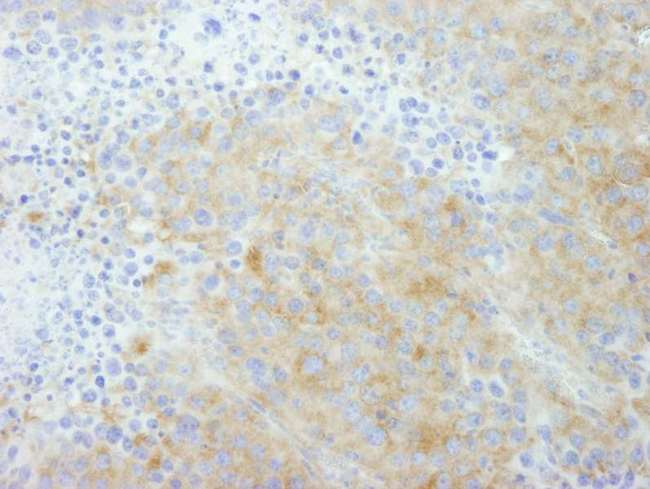 PTP-PEST / PTPN12 Antibody - Detection of Mouse PTPN12/PTP-PEST by Immunohistochemistry. Sample: FFPE section of mouse renal cell carcinoma. Antibody: Affinity purified rabbit anti-PTPN12/PTP-PEST used at a dilution of 1:250. Detection: DAB staining using Immunohistochemistry Accessory Kit.