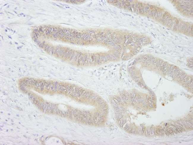 PTP-PEST / PTPN12 Antibody - Detection of Human PTPN12/PTP-PEST by Immunohistochemistry. Sample: FFPE section of human colon carcinoma. Antibody: Affinity purified rabbit anti-TPN12/PTPPEST( ) used at a dilution of 1:250.
