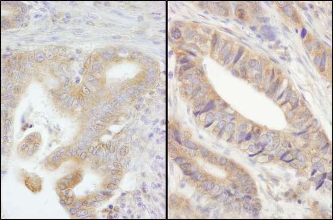 PTP-PEST / PTPN12 Antibody - Detection of Human PTPN12/PTP-PEST by Immunohistochemistry. Sample: FFPE section of human stomach carcinoma (left) and colon carcinoma (right). Antibody: Affinity purified rabbit anti-PTPN12/PTP-PEST used at a dilution of 1:200 (1 ug/ml). Detection: DAB.