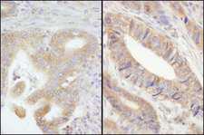 PTP-PEST / PTPN12 Antibody - Detection of Human PTPN12/PTP-PEST by Immunohistochemistry. Sample: FFPE section of human stomach carcinoma (left) and colon carcinoma (right). Antibody: Affinity purified rabbit anti-PTPN12/PTP-PEST used at a dilution of 1:200 (1 ug/ml). Detection: DAB.