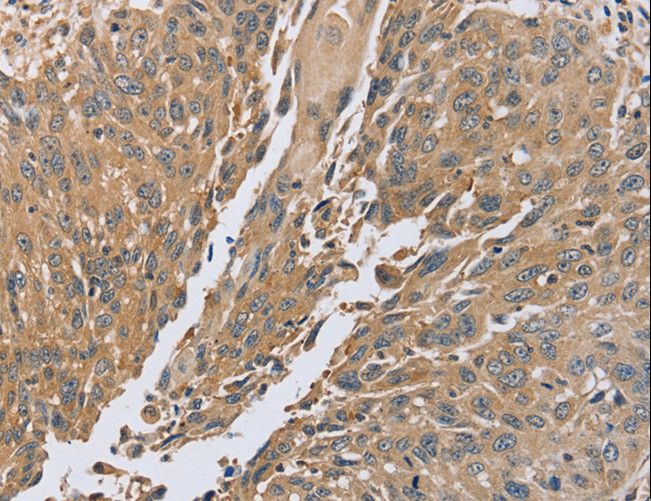 PTP-PEST / PTPN12 Antibody - Immunohistochemistry of paraffin-embedded Human lung cancer using PTPN12 Polyclonal Antibody at dilution of 1:45.