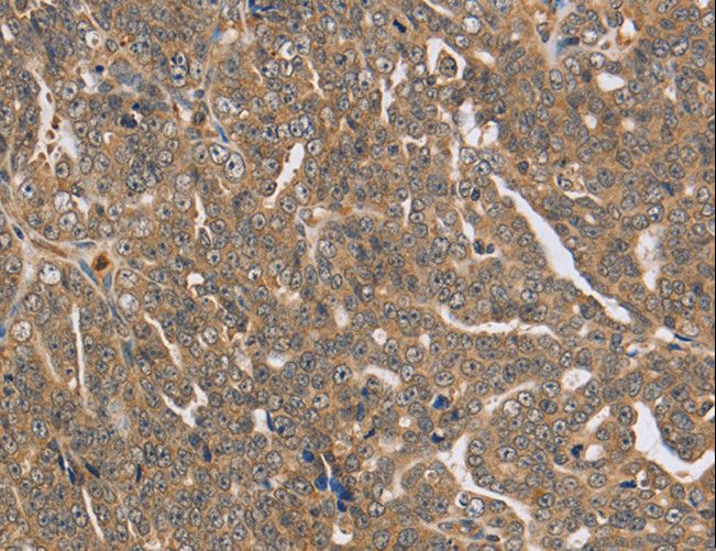 PTP-PEST / PTPN12 Antibody - Immunohistochemistry of paraffin-embedded Human cervical cancer using PTPN12 Polyclonal Antibody at dilution of 1:45.